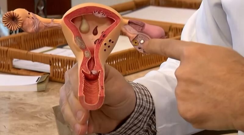 Edital do CNPq vai financiar pesquisas sobre endometriose